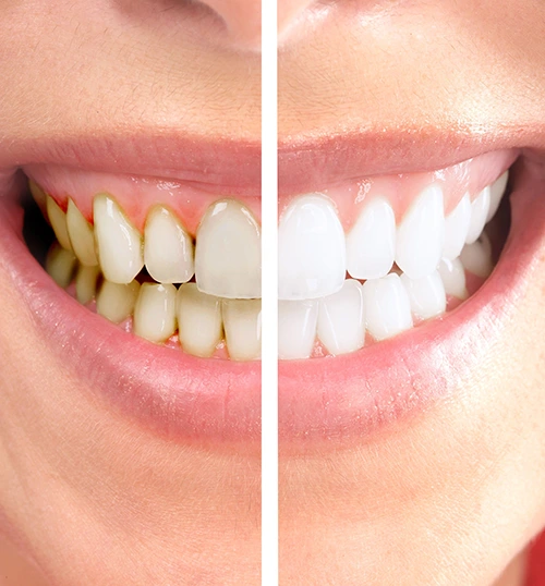 Teeth Whitening